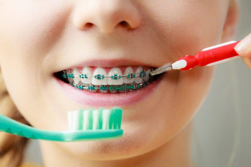 Pielęgnacja zębów a aparat ortodontyczny