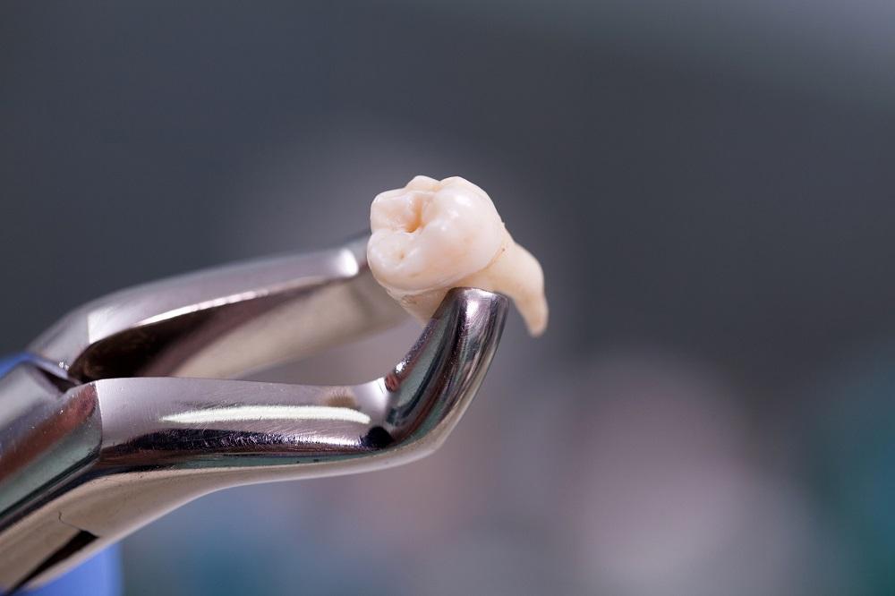 Chirurgiczne usuwanie zębów – przebieg zabiegu