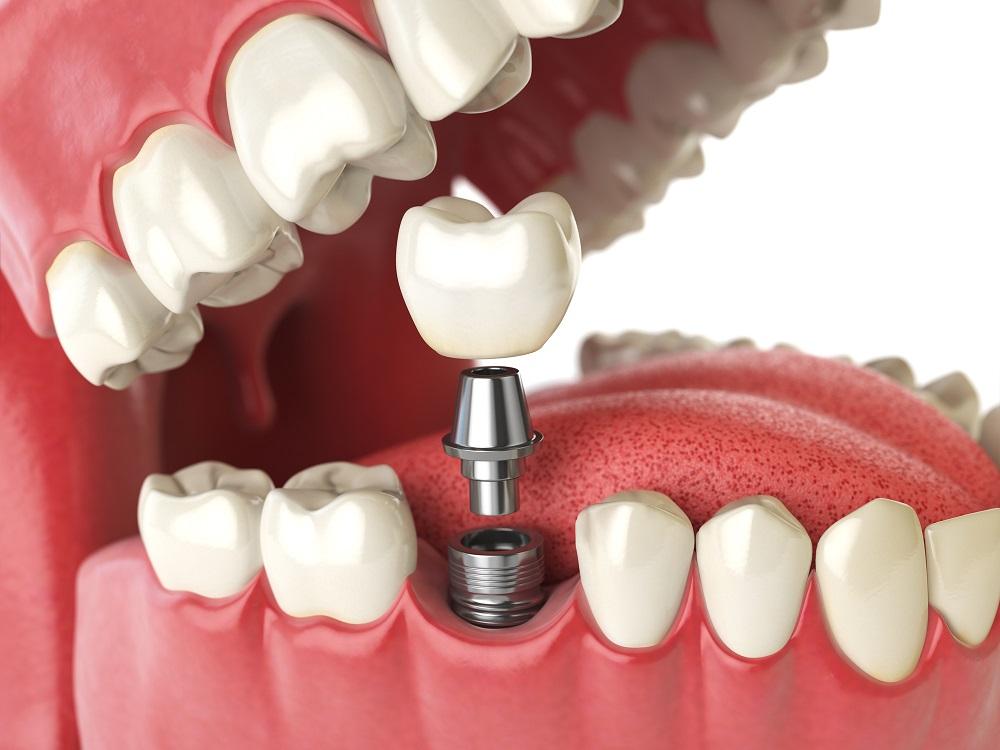 Budowa implantów zębowych